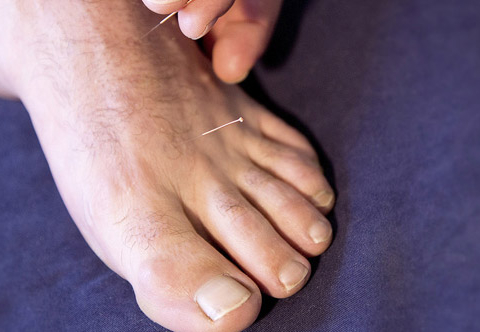 services-dry-needling